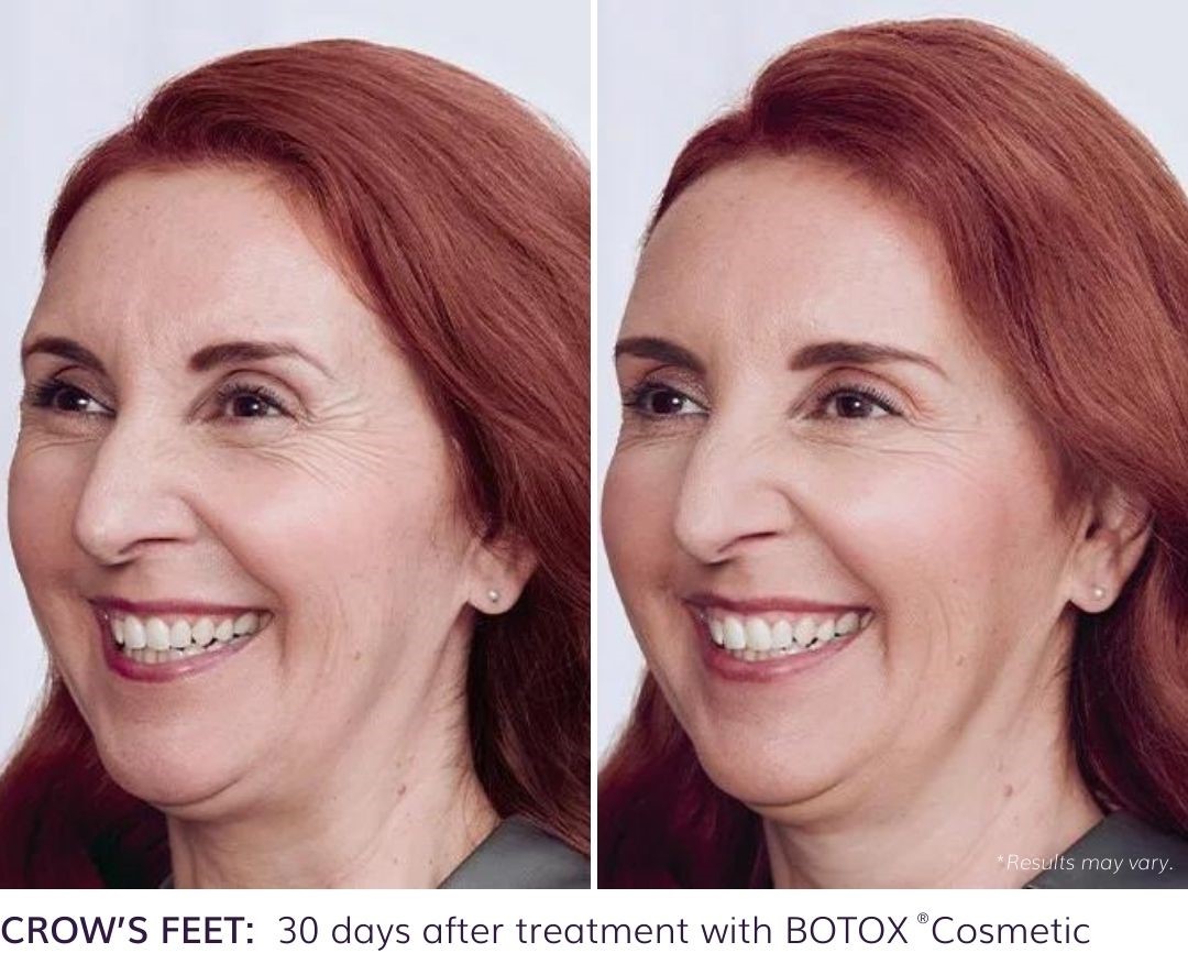 botox before and after image