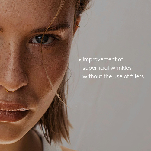 improvement of superficial wrinkles without the use of fillers.