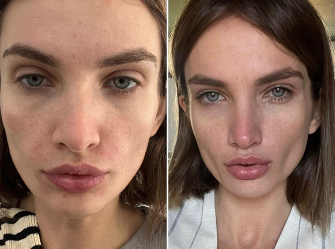 PROFHILO Before & After 3