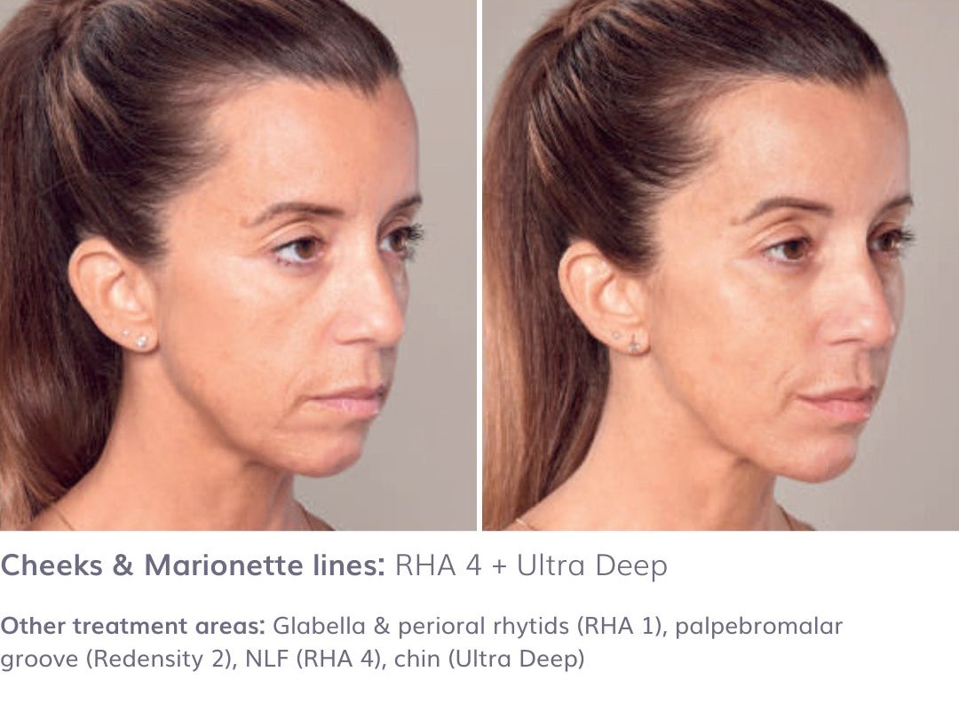 cheeks & marionette lines: RHA 4 + ULTRA DEEP