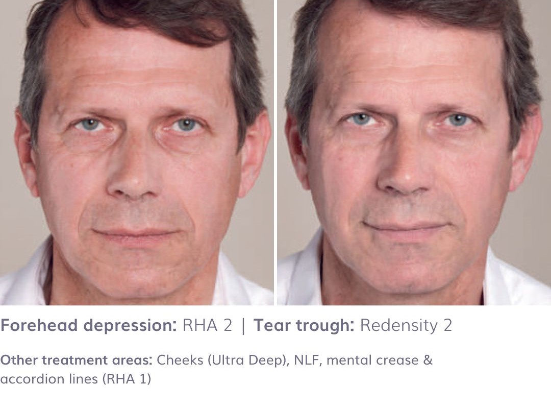 Forehead Depression: RHA 2 | Tear Trough: REDENSITY 2