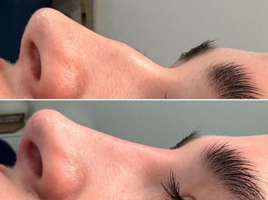 UTH FINE Before & After 2