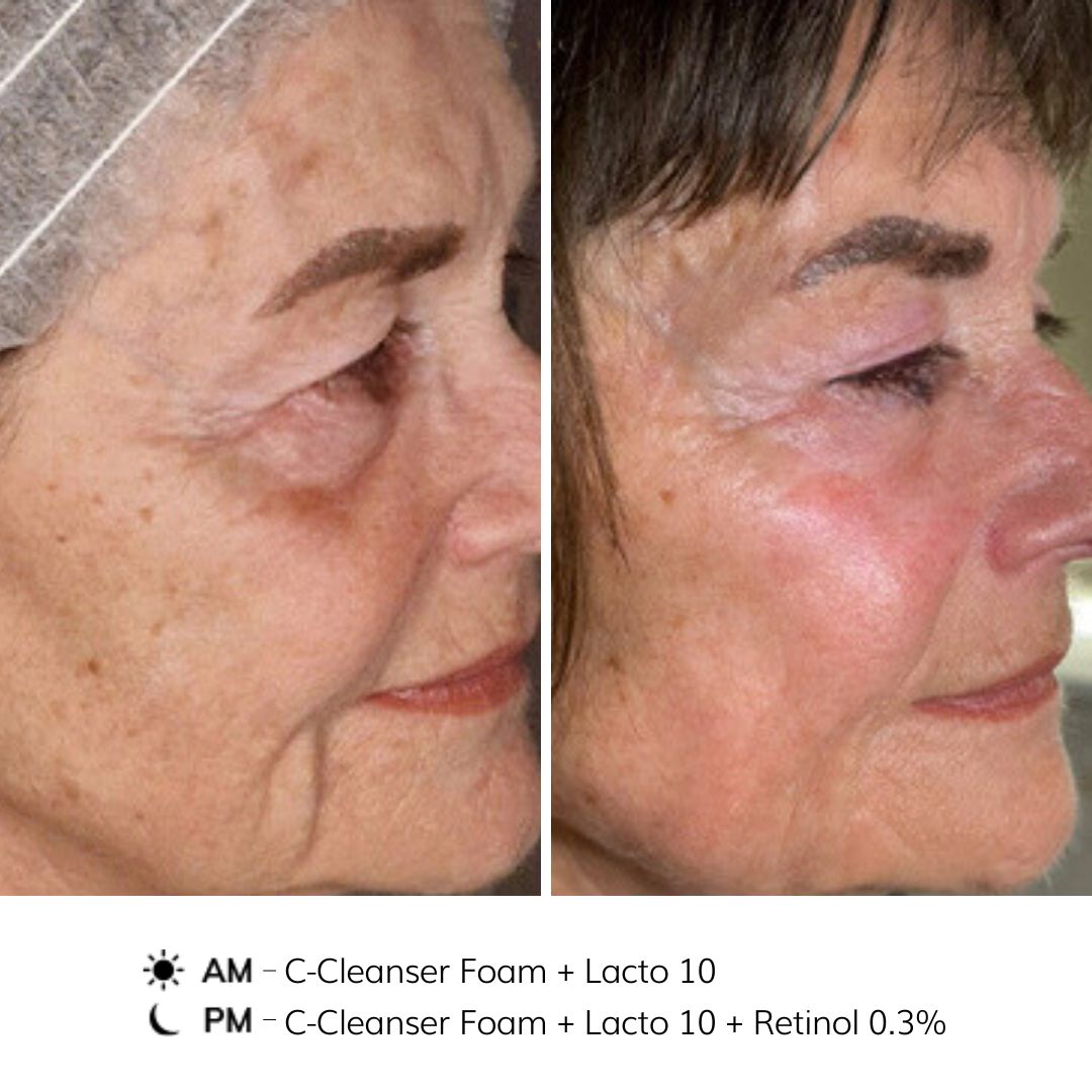 NOON Before & After - Anti-ageing