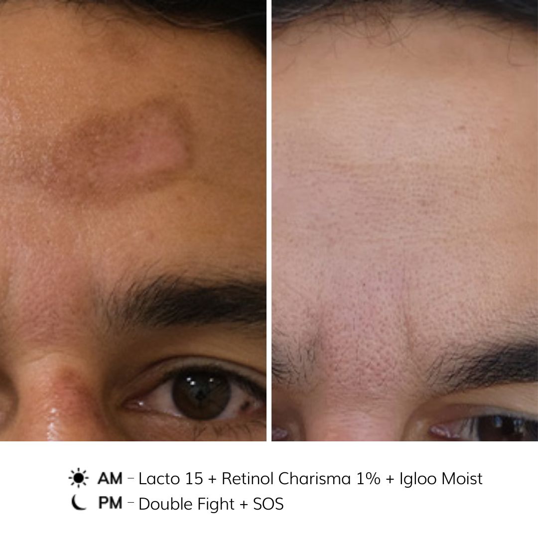 NOON Before & After - Scar