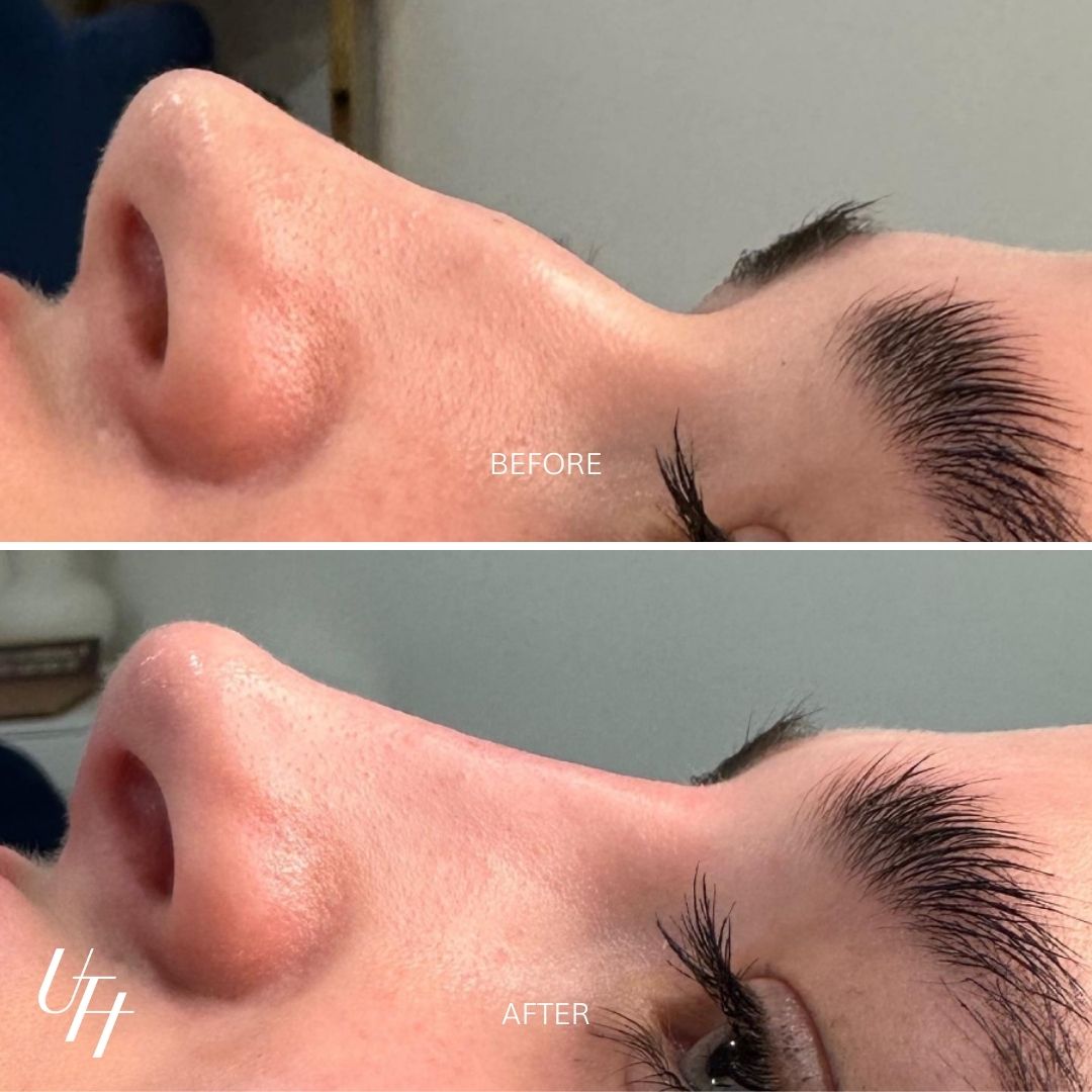 UTH FINE 02 Before & After