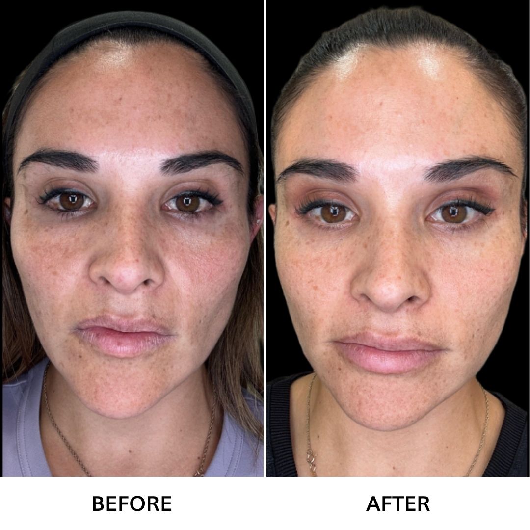 RexoFace Before & After