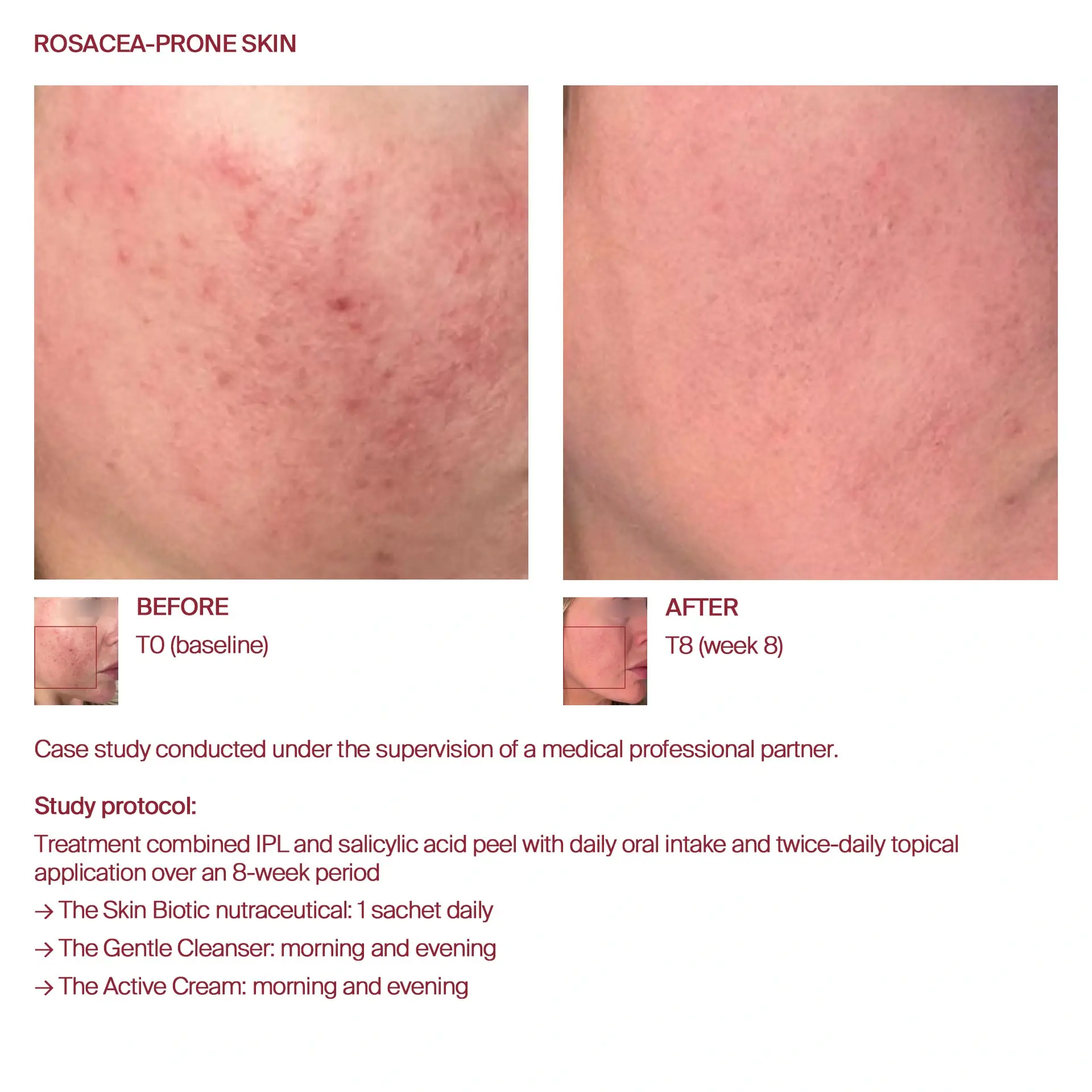 AWvi before and after rosacea