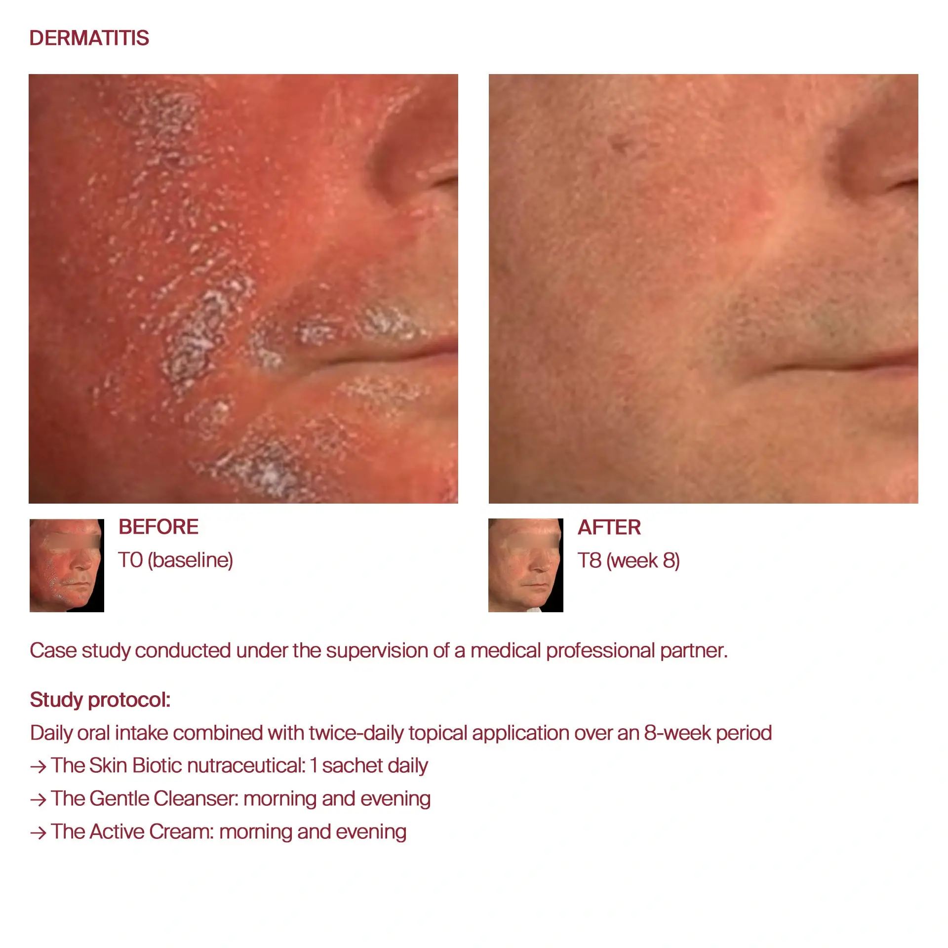 AWvi before and after dermatitis