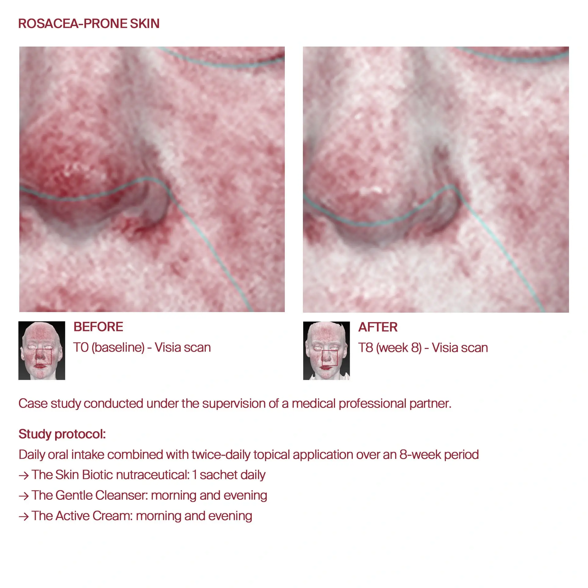 AWvi before and after rosacea