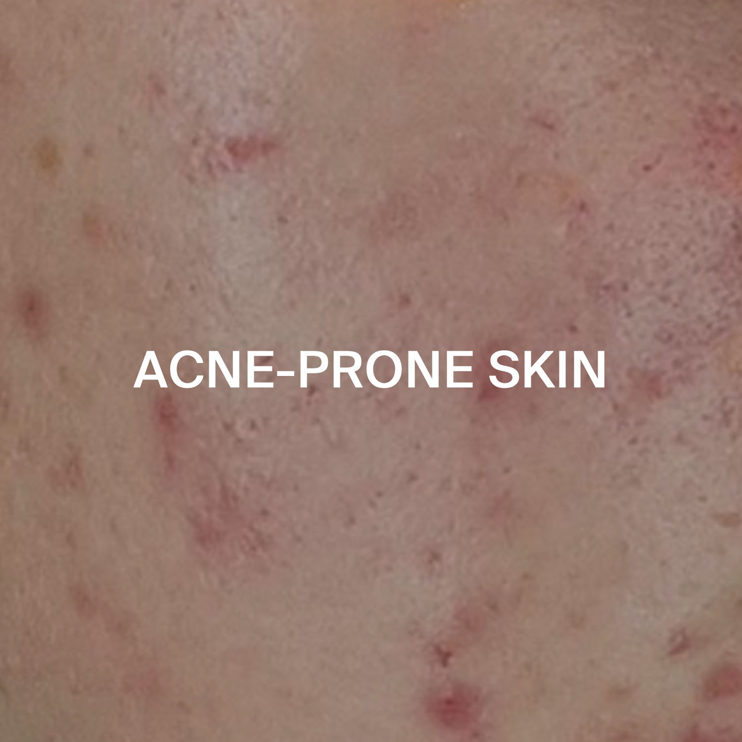 Acne-prone skin