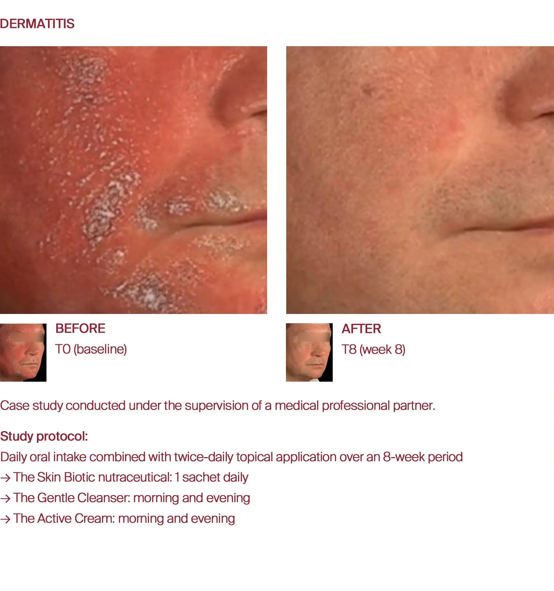Dermatitis before and after