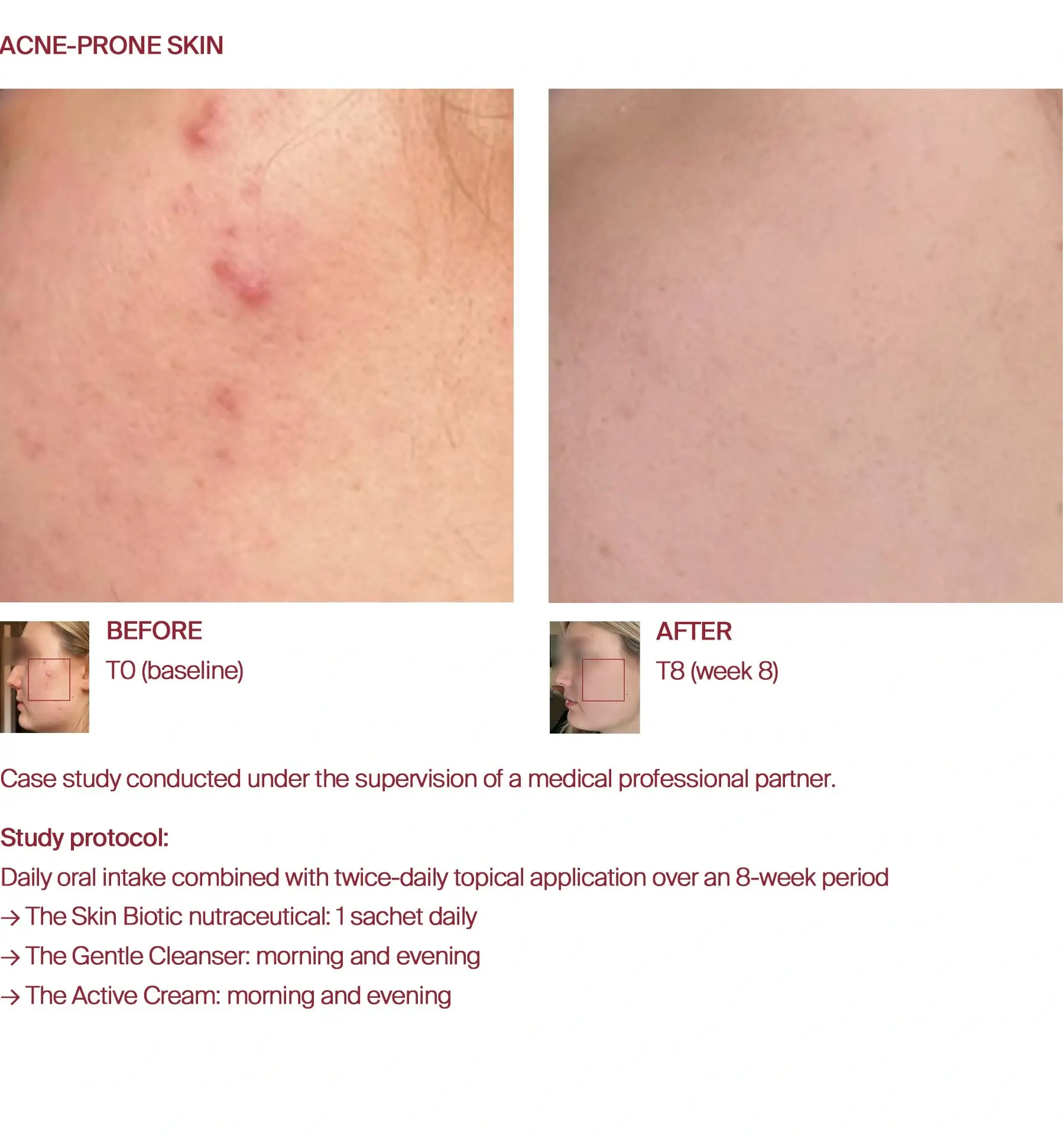 Acne-prone skin improvement before and after