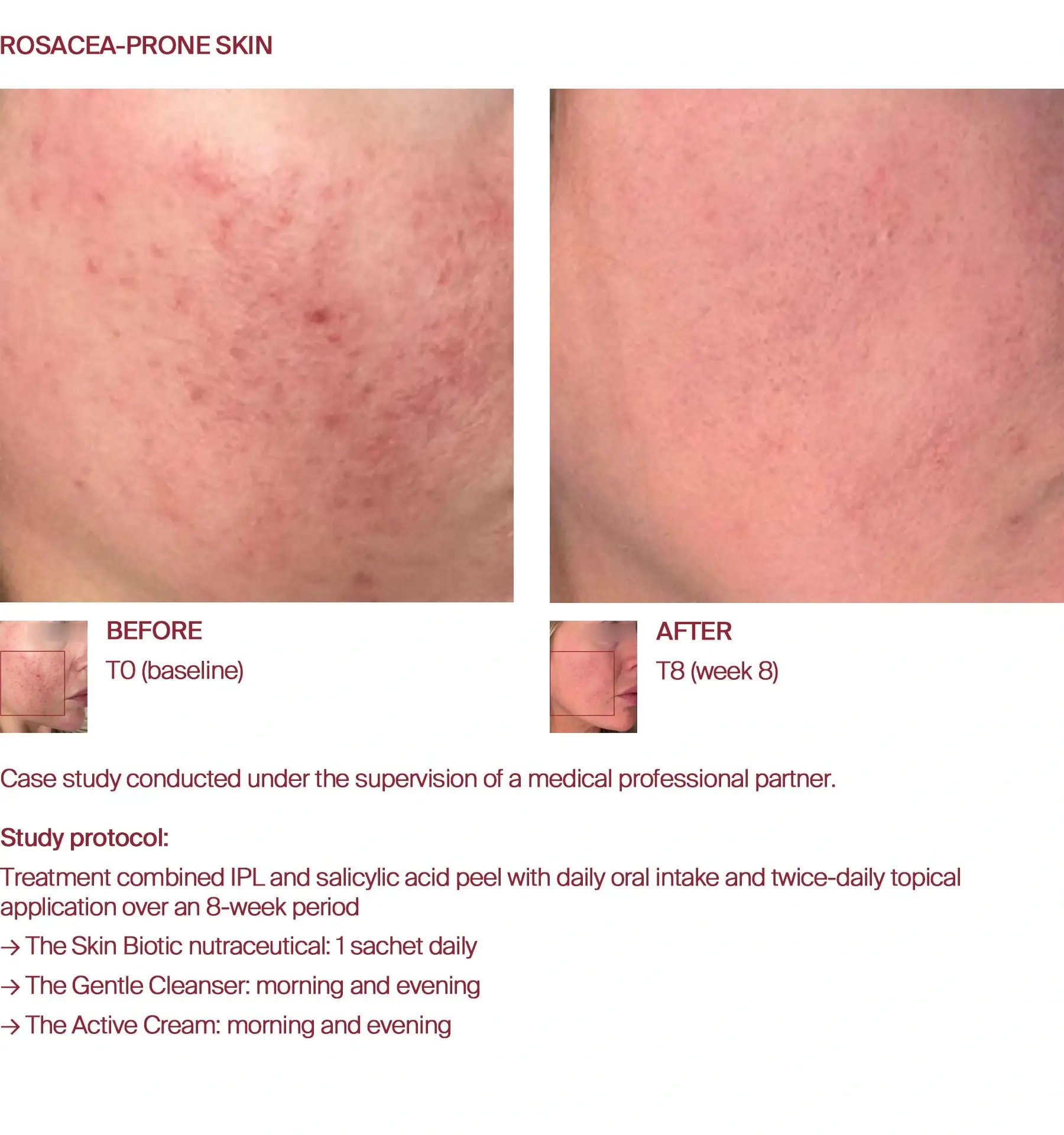 Rosacea before and after