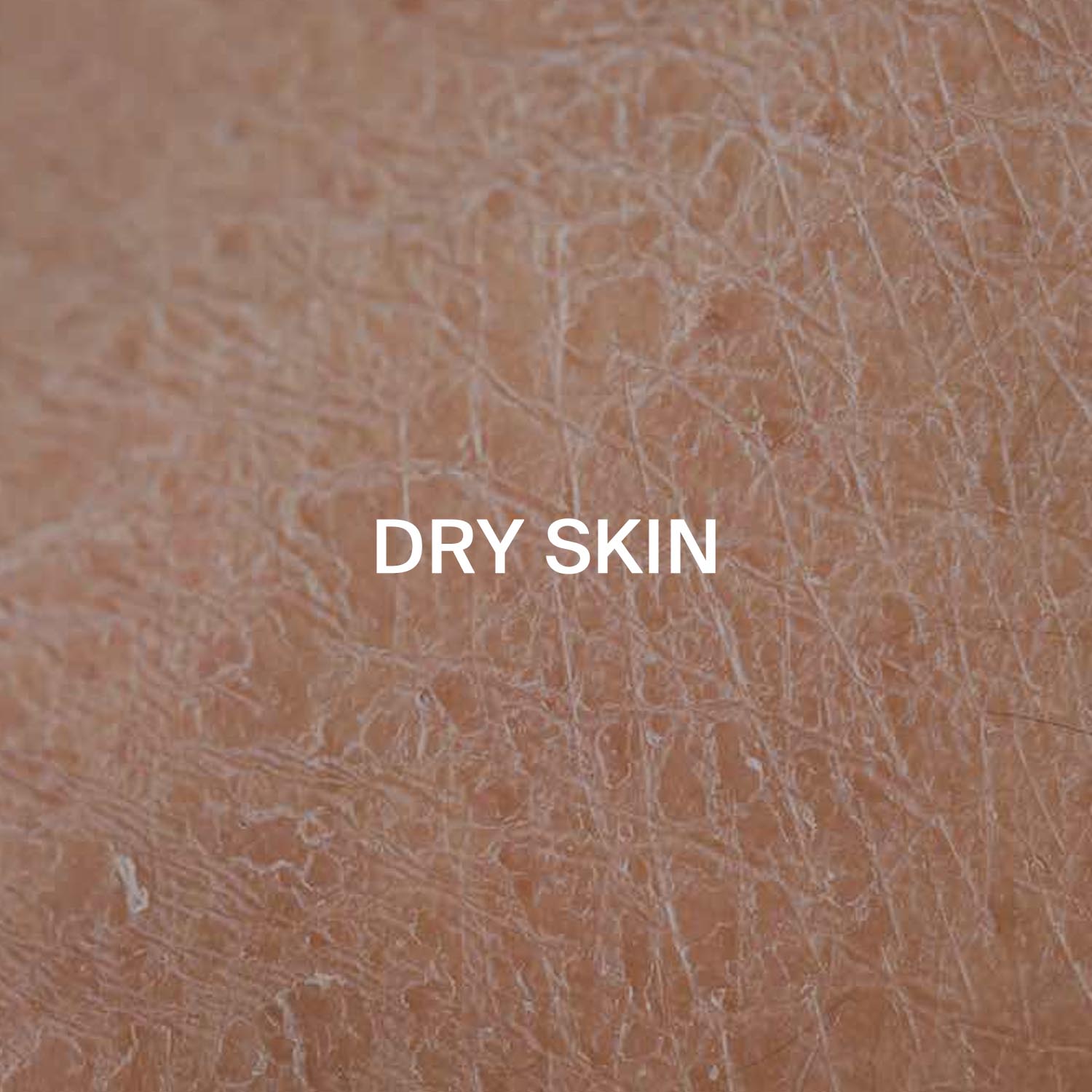 Dry skin