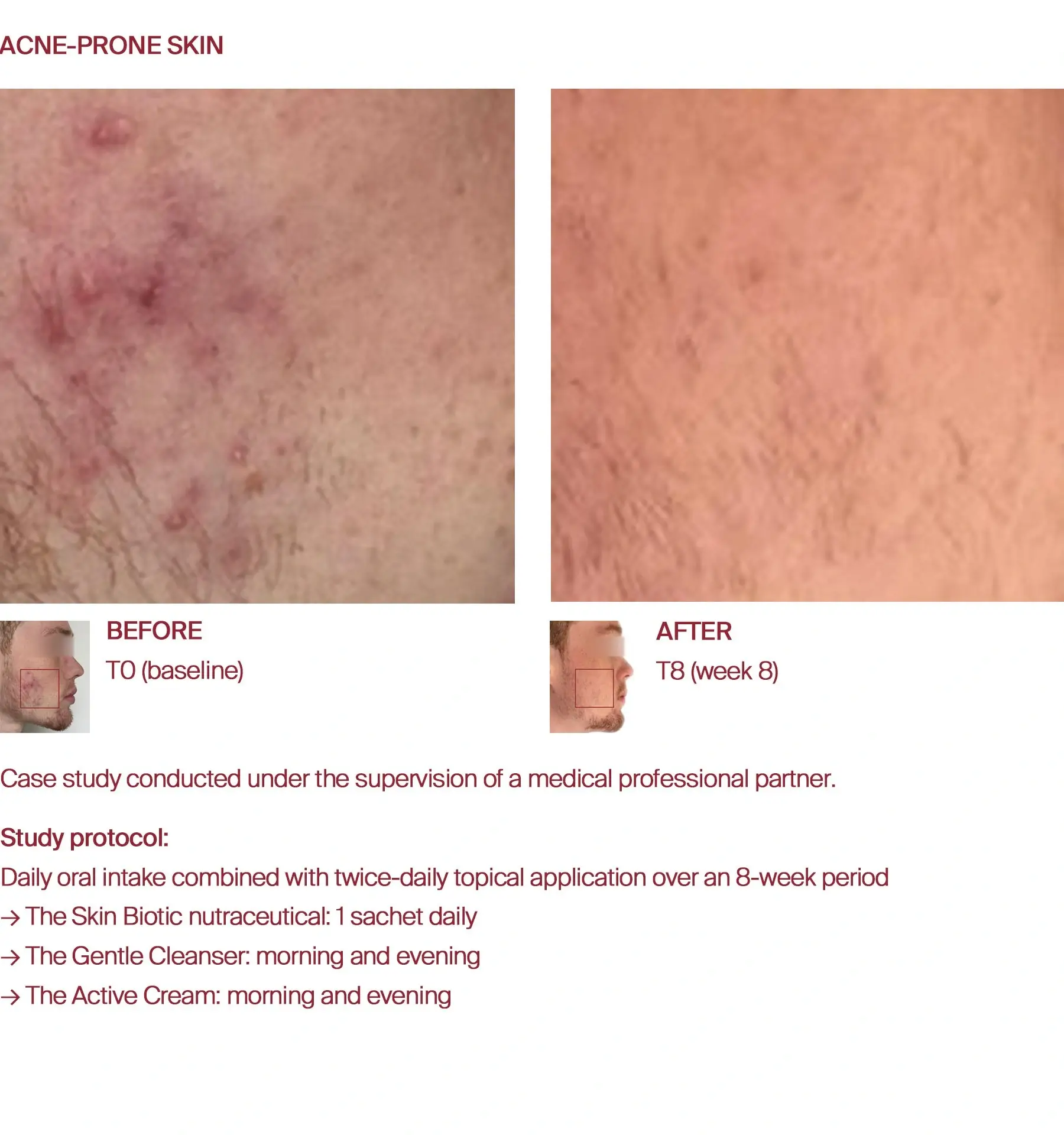 Acne-prone skin texture before and after