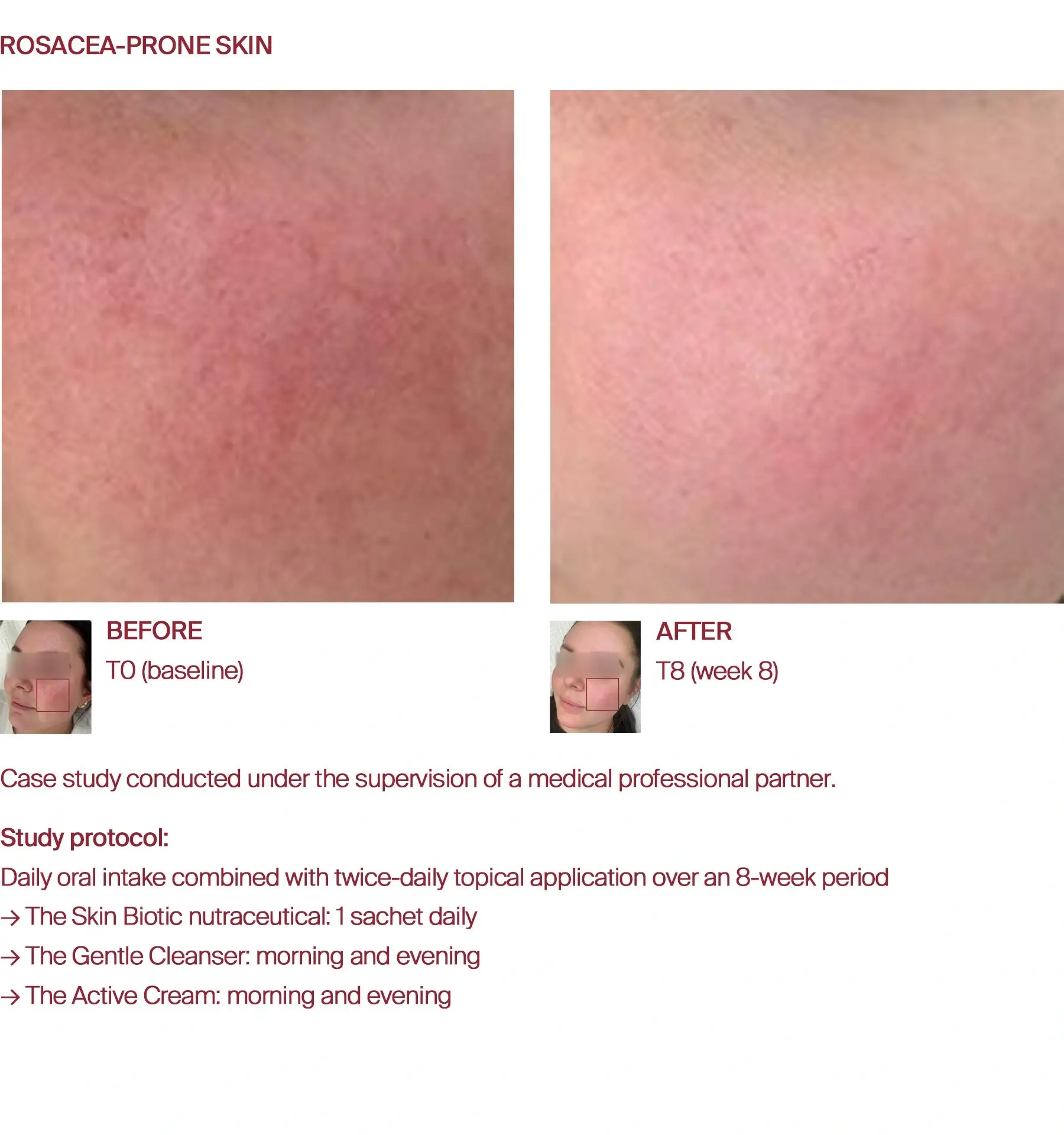 Rosacea improvement before and after