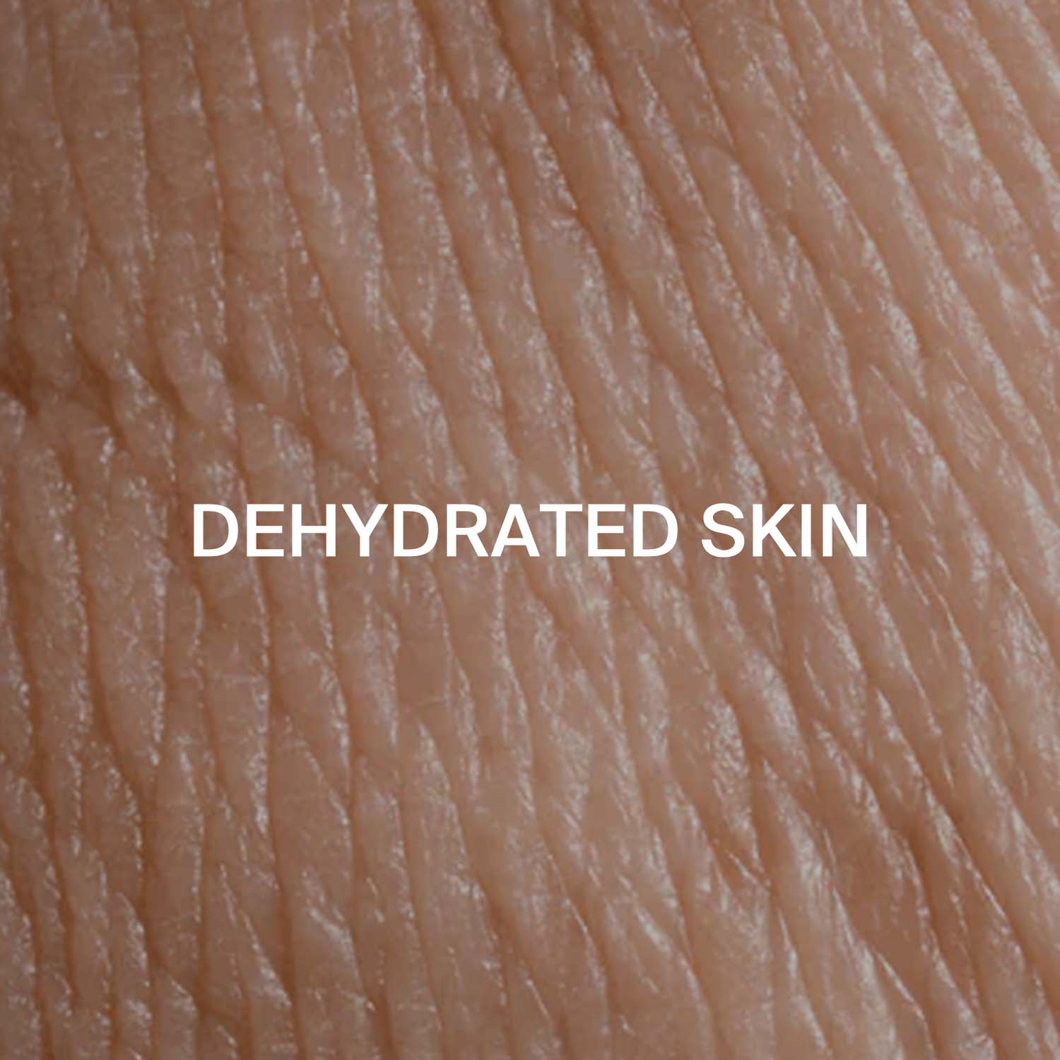 Dehydrated skin
