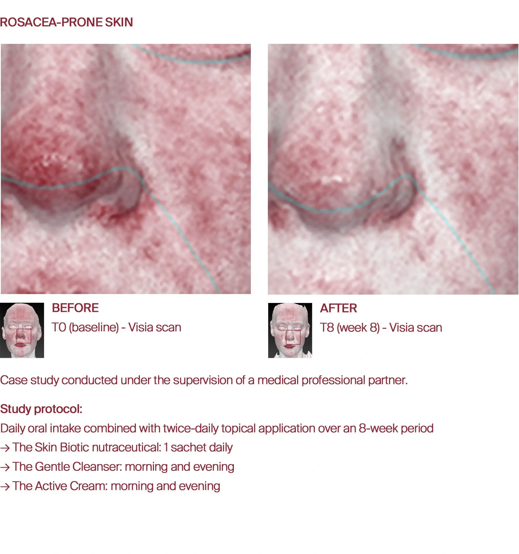 Rosacea redness reduction before and after