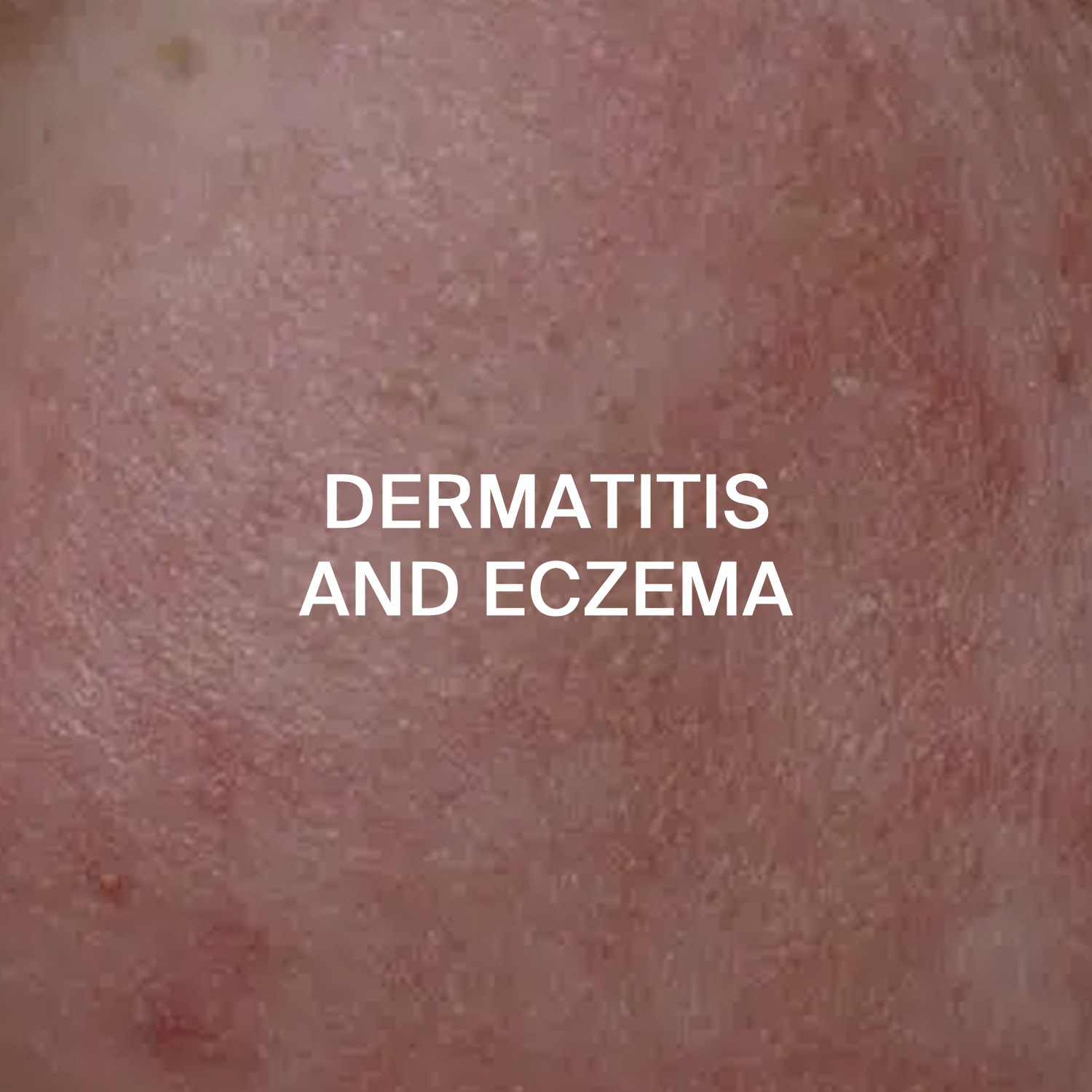 Dermatitis and Eczema