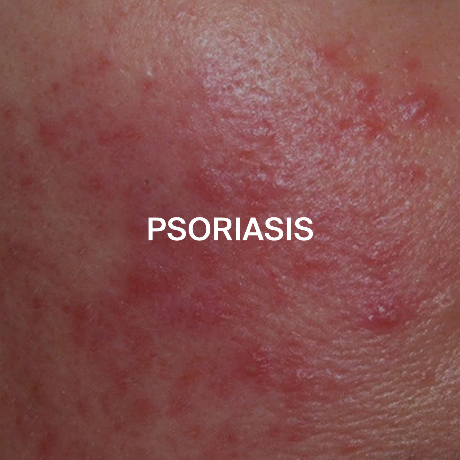 Psoriasis