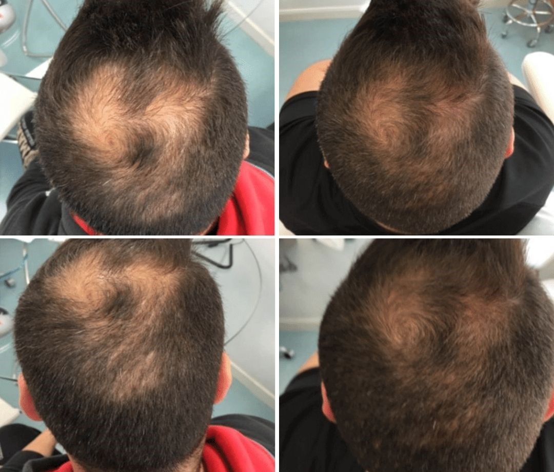 plinest hair before and after