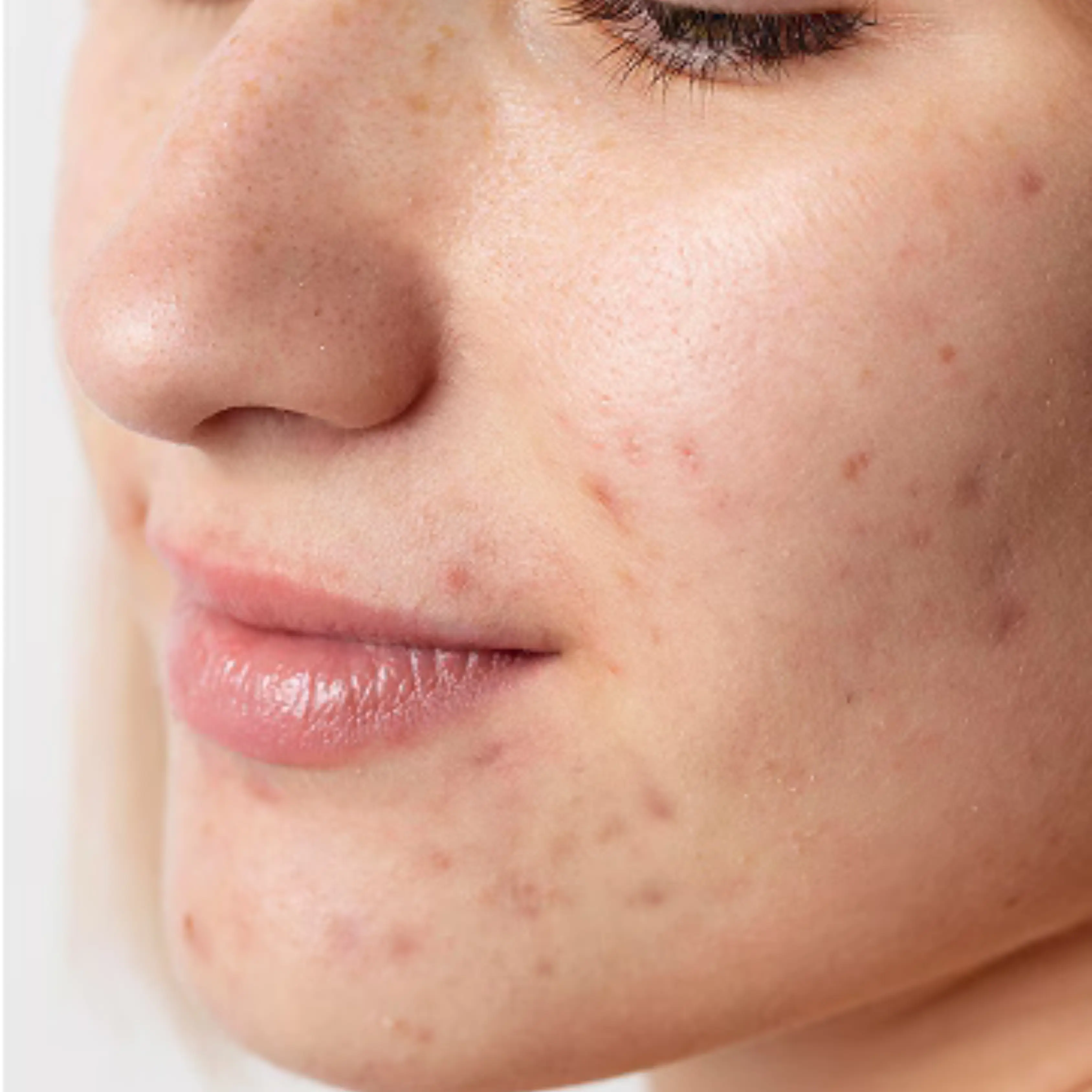Acne female model shot