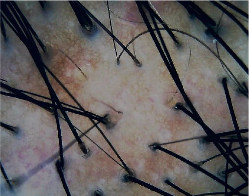 A scalp under cross polarised light