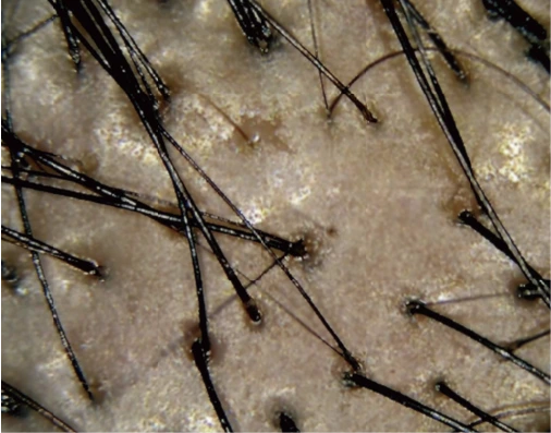 A scalp under parallel polarised light